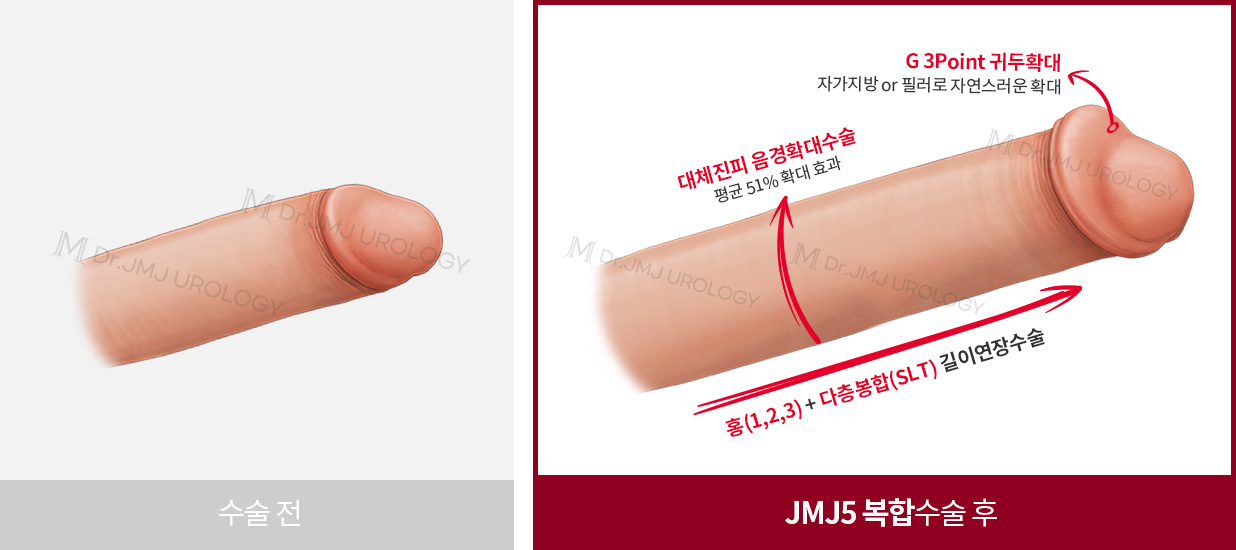 수술전, JMJ5 복합수술 후 대체진피 음경확대수술 30% 확대 효과, G 3Point 귀두확대 자가지방 or 필러로 자연스러운 확대, 홍성우 길이연장수술 최대 6cm 증가