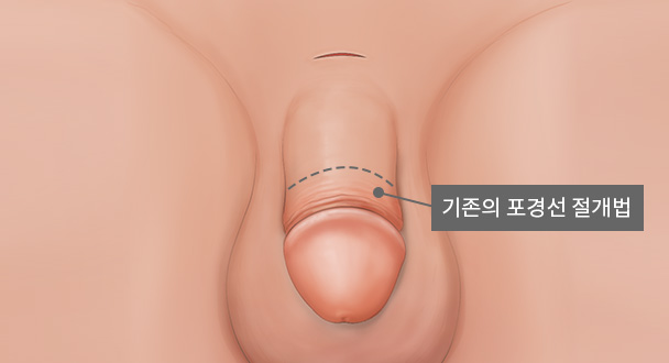 기존의 포경선 절개법 이미지